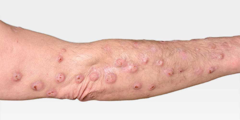 Dr. Ahu Çiler Turgut Prurigo nodularis