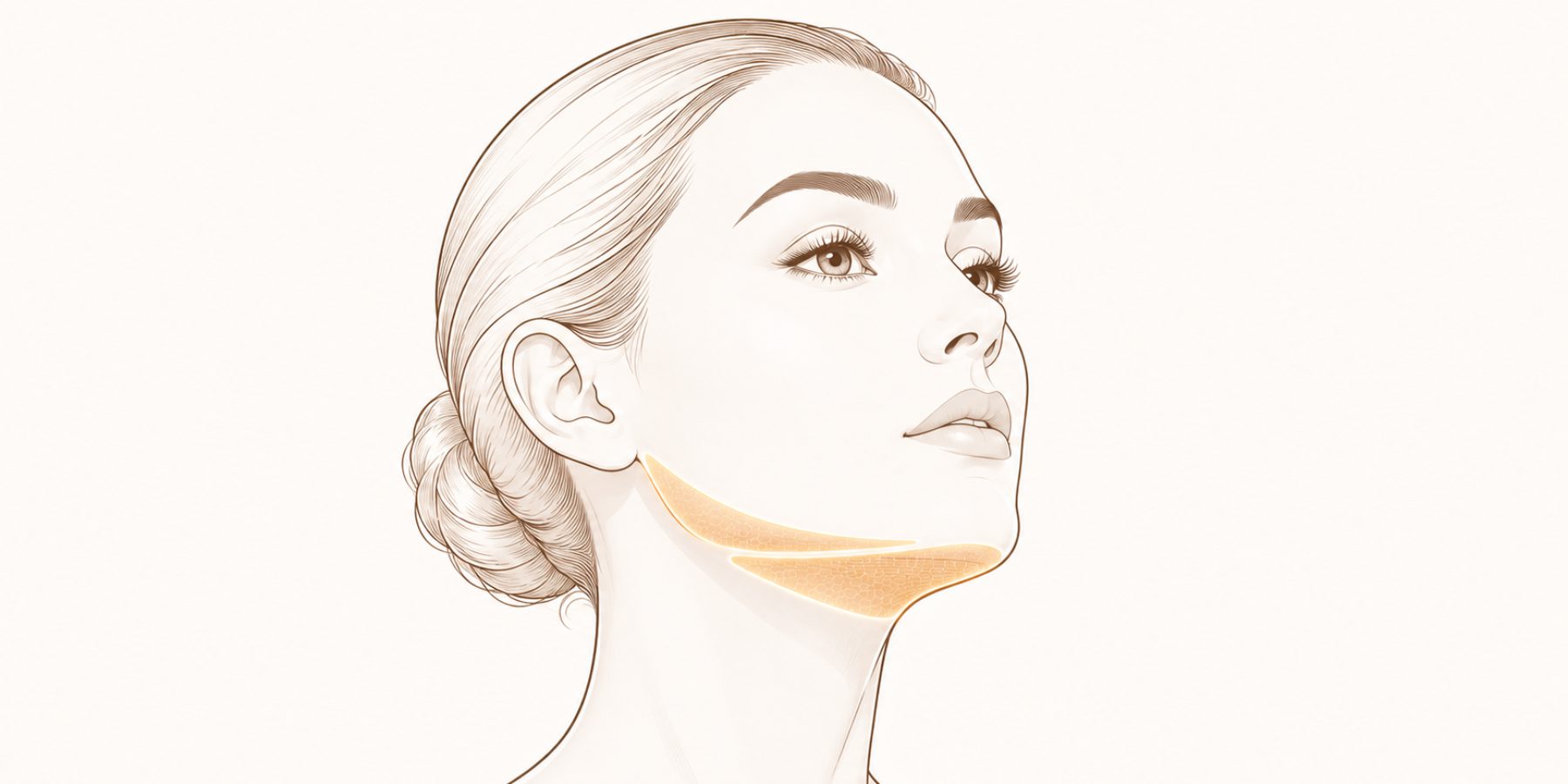 Endolift ile hedeflenen çene altı ve çene hattı bölgesini gösteren şema